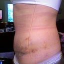 2 weeks PO Side