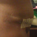 1.5 Weeks Drain remove side 1