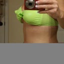 4 weeks post op side view