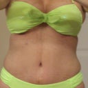 front view 4 week po