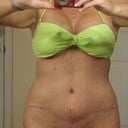 picture of my scar at 4 weeks post op looks pretty good i think
