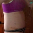 5 days po....side view....looks like i should have had them put the fat in my arse....i have none :-)