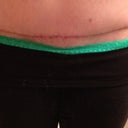 5 Weeks PO scar.  Still red, but healing very nicely.