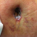 This is post opd 9 the clear string is the stitches the clear goo is the aquaphor. you can see how in the bottom its all bubbly and the inside is a darker shade. did I f-ed up?....