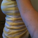 2 weeks post op