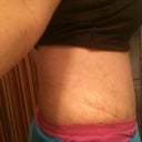 Almost 2 weeks post op