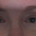 droopy  upper lids above the incision - looks terrible! i had surgery to get rid of this!