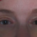 droopy upper lids