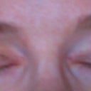 uneven incision (crease lines)