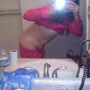 Tummy Tuck pre-op