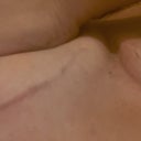 Using Scar Recovery Gel.  I only did the clevage area because I wanted to see if it really helped.
