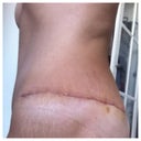 Almost 2 wks after revision