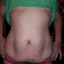 Muscles were seperated to the point where you see it stick out on both sides.