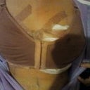 First day of surgery