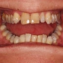 Incisal Edges January 2012 Attachments added
