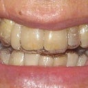 Aligner #13 Day 1 with pontic lateral incisor LHS