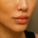 after juvederm in nasal folds and upper and lower lips, day 3