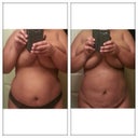 Pre-Op && 2nd Day Post Op