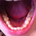 My bottom teeth; as you can see, my front bottom teeth have minor crowding.