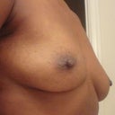 Before - side
