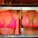 9 days post op. The obvious before and after. (with 450cc moderate plus profile smooth round silicone unders) Hoping they continue to drop and fill in beneath, they look great but I'm not a fan on the "round, hard" look. Same bathing suit top although it appears different color