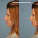 This was my before picture along with the computerized rendering of the "after photo"