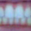 This is as good as it gets for me. Straight but my back teeth no longer touch, and i have a small open area on the right side.