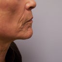 Ablative Laser Resurfacing
