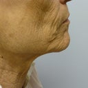 Ablative Laser Resurfacing