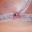 Post op day 20 T section of the right one