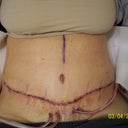 Day 3 post surgery.  Pain pump has been removed.  Still hanging in there.  Drains are a pain...