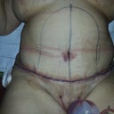 Post-op day 2. Looking a little pudgy