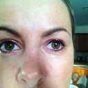 5 hours after- more ointment on