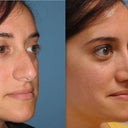 Angle View, Before and After