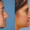 Side View, Before and After