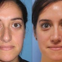 Front View, Before and After