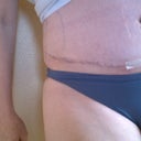 These pics were taken today, 8 days PO. There is still some blue marking and steristrips on one half, but I wanted to capture what my scars currently look like.