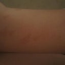 few scars on arm