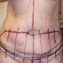 Pre surgery markings