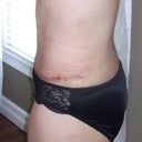 2 weeks Post Op scar and side view