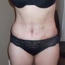 2 weeks Post Op front View. Still Swollen