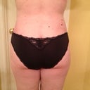 Post Op 8 weeks, back