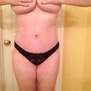 Post Op 8 weeks, front