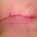 Post Op 8 weeks, left scar