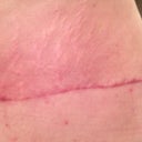 Post Op 8 weeks, left side & butt, scar