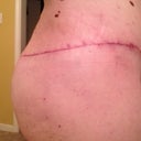 Post Op 8 weeks. left side & butt, scar