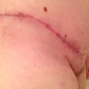 Post Op 8 weeks, right side scar