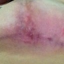 Left under healed 11 weeks