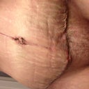 17 days PO, first time I changed the tape....
Ewwww....