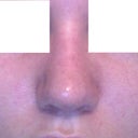 My nose after my surgeon pushed the bone back in place.
